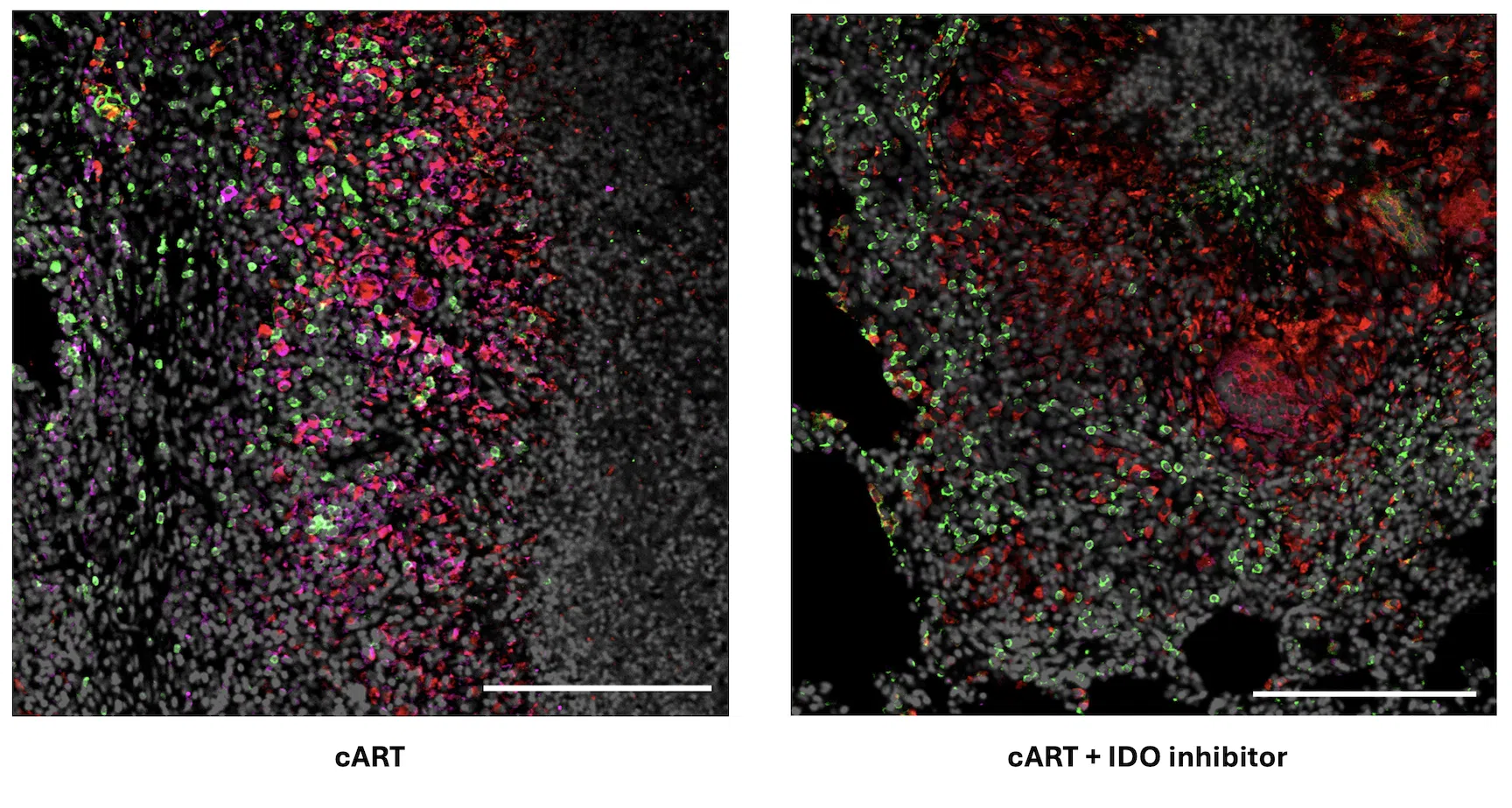 Promising TB therapy safe for patients with HIV